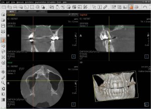 CBCT image example of sinuses