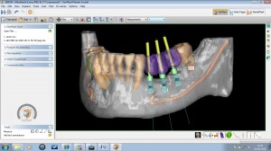 Dr Colin Neil dental implant simplant facilitate mandible example