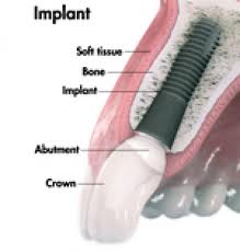 labelled Astra implant diagram