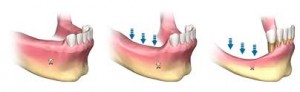 bone loss after tooth loss mandible